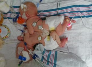 Conjoined Twins Conner and Carter Embraced by Community Conjoined Twins