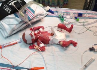 Born Too Soon: Our 1 Pound Miracle