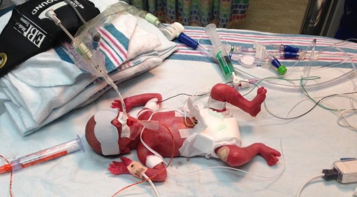 Born Too Soon: Our 1 Pound Miracle