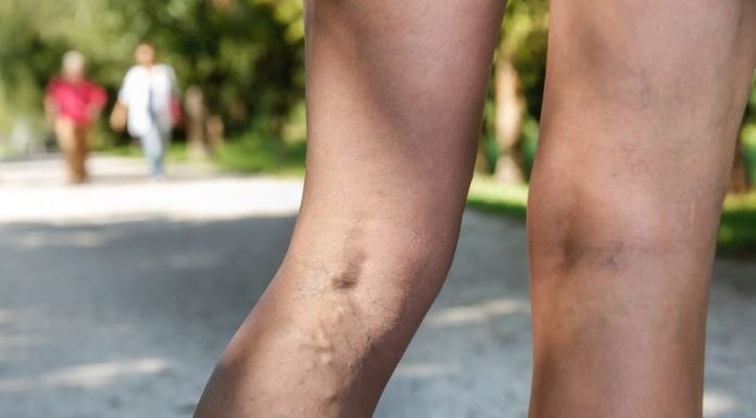 Unsightly Leg Veins: What Moms Need to Know