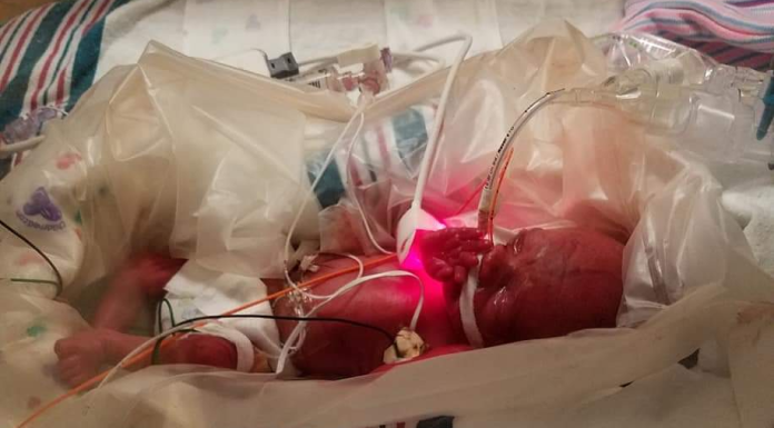 1 Pound, 7 Ounces: Life After the NICU nicu