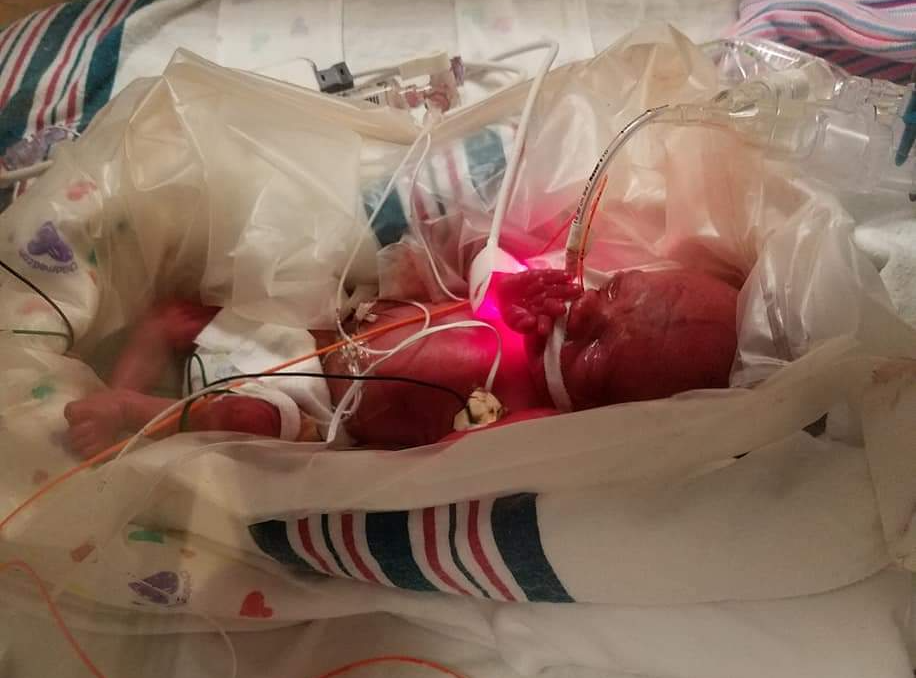 Baby born weighing 12 ounces at birth heads home from Florida hospital