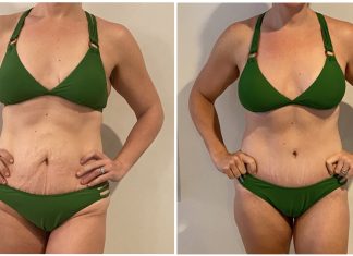 Mommy Makeover Part IV: Results and Reflections