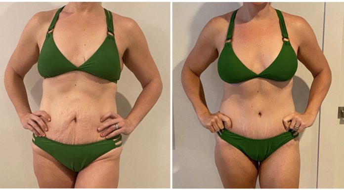 Mommy Makeover Part IV: Results and Reflections