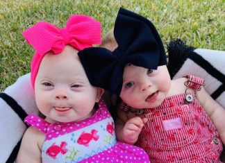 One (or Two!) In a Million: ‘Rare’ Twins Born With Down Syndrome down syndrome
